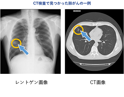 胸部CT検査