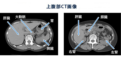 上腹部CT検査