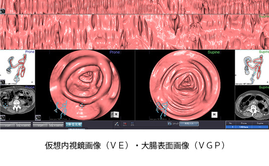 大腸CT検査