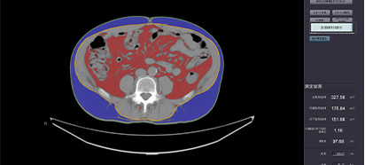 内臓脂肪CT検査