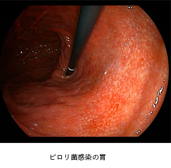 内視鏡検査の画像