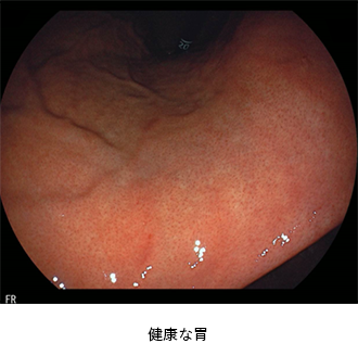 内視鏡検査の画像