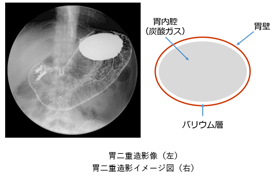 胃二重造影像