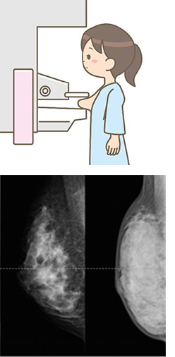 マンモグラフィー検査の画像